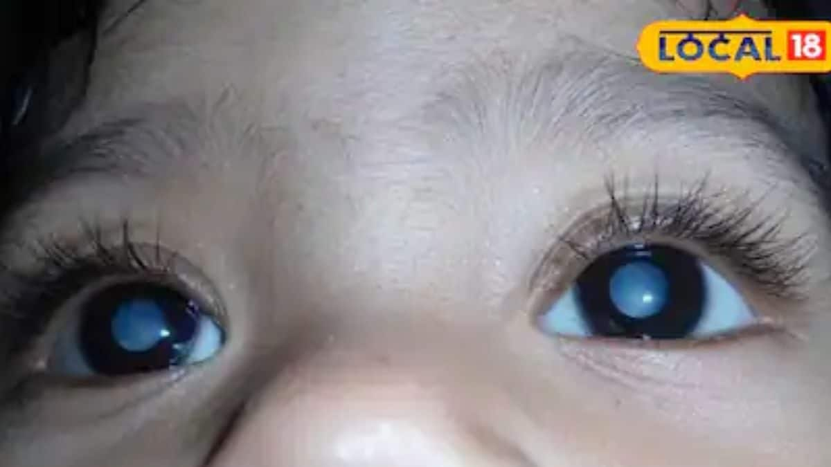 Cataracts in Children: Experts Explain Prevention and Treatment ...