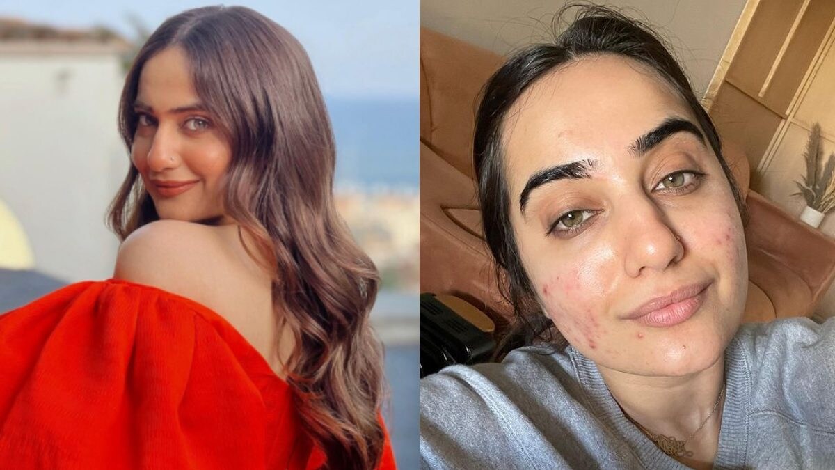 Kusha Kapila Reveals How She Got Rid Of Acne, Recommends Diet Changes And Home Remedies – News18