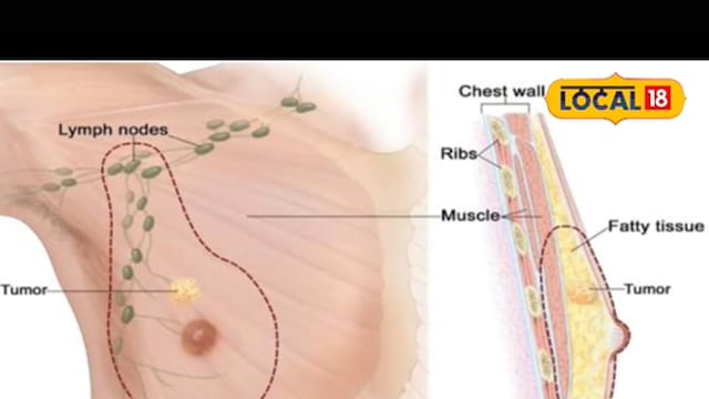 Why Is Breast Cancer Rising Among Men? A Look At Causes, Symptoms And