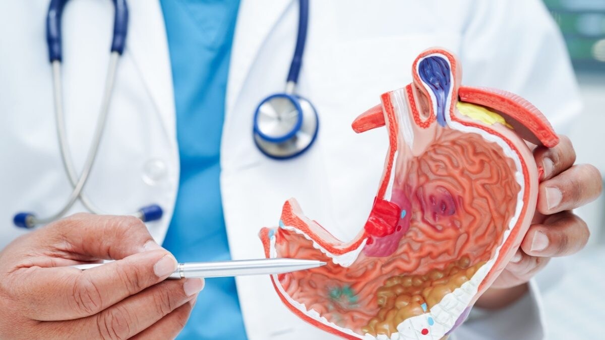 The Silent Threat: Understanding Stomach Cancer – News18