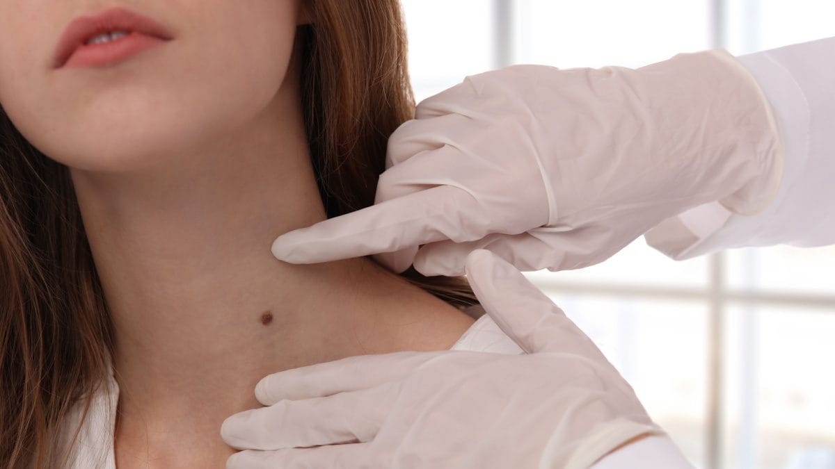 Are Skin Tags Cancerous? Find Out Here – News18