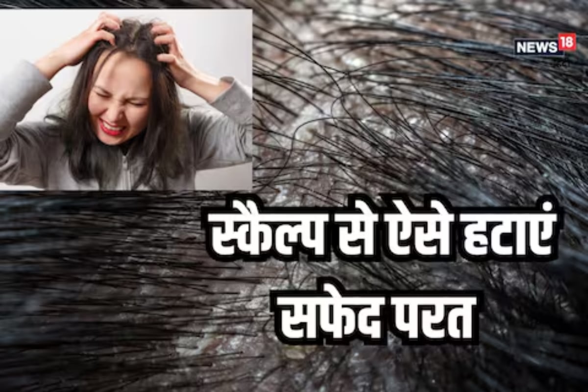 5 Tips To Prevent Dandruff And Hairfall In The Winter