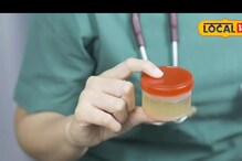 Foam In Urine Could Be A Sign Of Protein Loss, Here's How To Prevent It