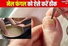 Simple And Effective Home Remedy To Treat Fungal Infection In Nails