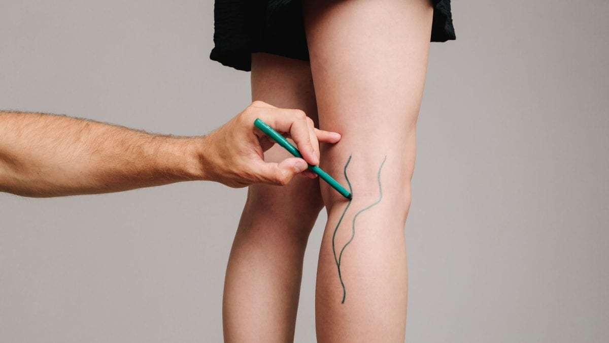 Blood Clots On Legs: Causes And Ways To Avoid