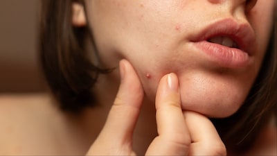 PCOS affects skin and hair due to hormonal imbalances.