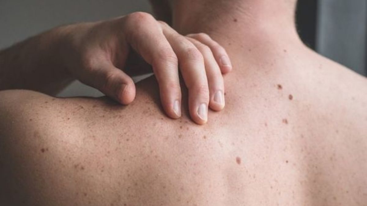 Can High Cholesterol Affect Your Skin? Know The Symptoms And How To ...