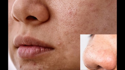 Blackheads form when pores become clogged with excess sebum (oil), dead skin cells, and impurities. (News18 Hindi)