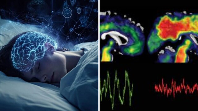 The condition is caused by the gradual degeneration and death of brain cells, which disrupts communication between neurons. (Representative Image)
