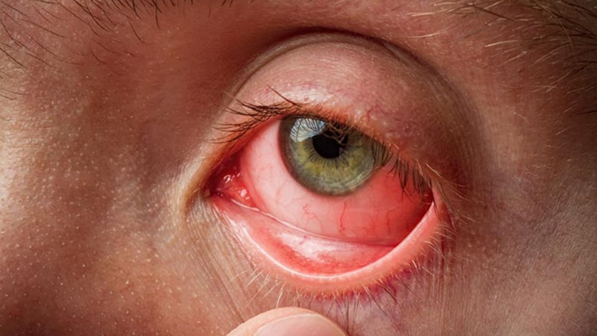 Will You Develop Dementia? Your Eyes Can Tell You 12 Years In Advance, Says Study | Lifestyle News