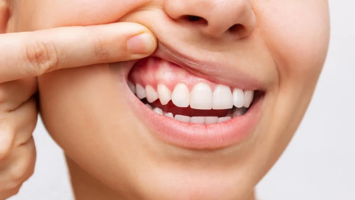 From Mouth To Heart: How Oral Bacteria May Secretly Trigger Heart Attacks