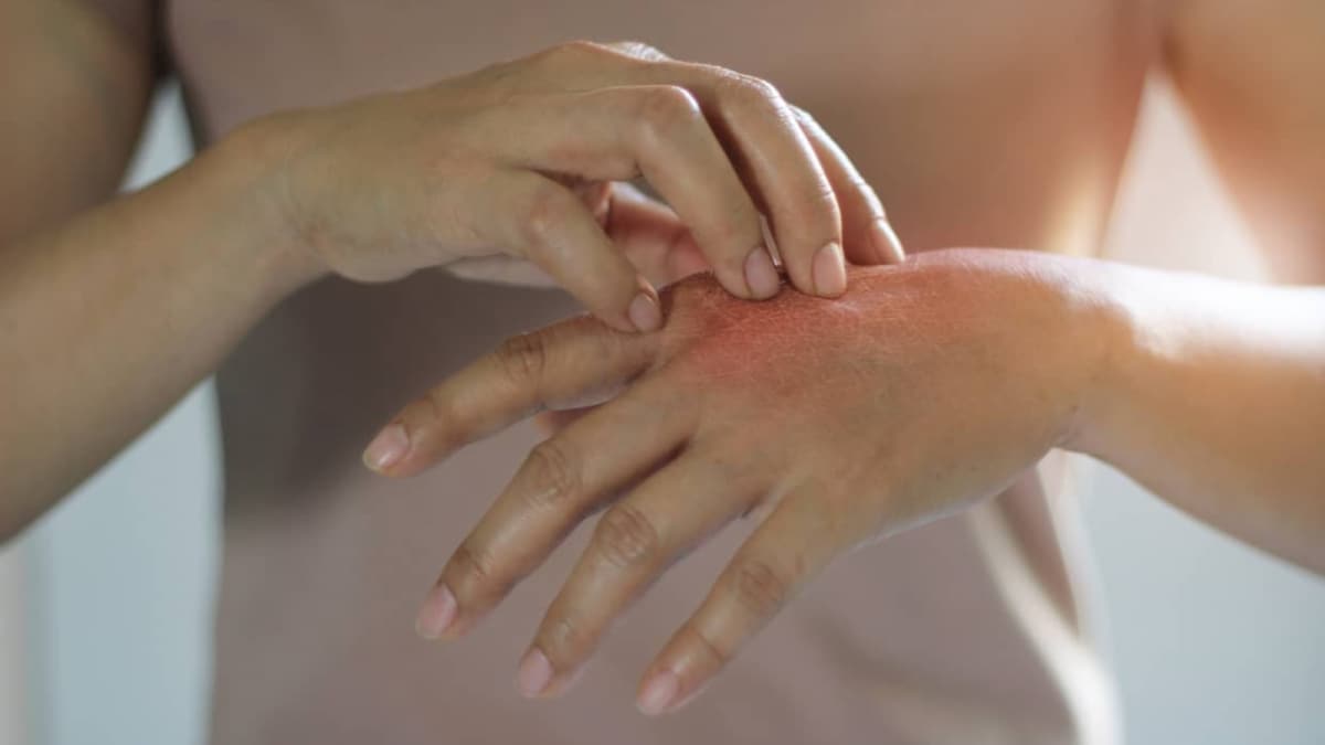 Australia’s Skin Cancer Crisis In Spotlight After Michael Clarke’s Health Update