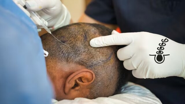 The diligent  developed an corruption  during the procedure, causing facial swelling and accelerated   decline. Treatment to prevention  him began excessively  late. (News18)