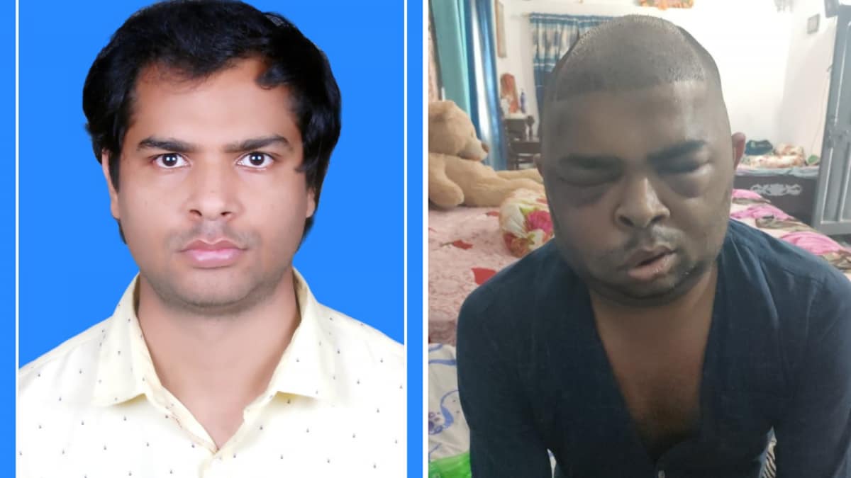 Is A New Hairline Worth Your Lifeline? Inside Kanpur's Growing Epidemic Of Botched Transplants