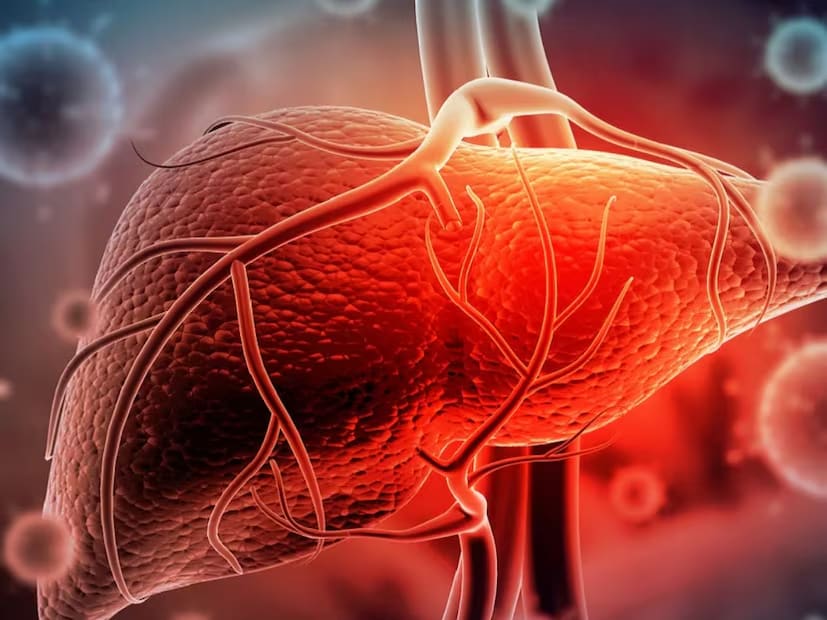 However, fatty liver disease is now being seen frequently, even in people who do not drink. The primary cause is poor dietary habits. Alarmingly, this condition is now affecting people at a young age. The good news is that if diagnosed early, fatty liver can be managed or even reversed with simple home remedies and lifestyle changes. (News18 Telugu) However, fatty liver disease is now being seen frequently, even in people who do not drink. The primary cause is poor dietary habits. Alarmingly, this condition is now affecting people at a young age. The good news is that if diagnosed early, fatty liver can be managed or even reversed with simple home remedies and lifestyle changes. (News18 Telugu)