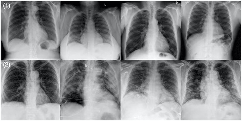 X-rays: X-rays are a type of electromagnetic radiation used in medical imaging. They were discovered in 1895 by Wilhelm Conrad Roentgen while conducting cathode ray experiments. When he saw a flashing light on a screen, he accidentally discovered X-rays, even though he was not looking for them. Many lives have been saved thanks to this accidental discovery. (News18 Tamil) X-rays: X-rays are a type of electromagnetic radiation used in medical imaging. They were discovered in 1895 by Wilhelm Conrad Roentgen while conducting cathode ray experiments. When he saw a flashing light on a screen, he accidentally discovered X-rays, even though he was not looking for them. Many lives have been saved thanks to this accidental discovery. (News18 Tamil)