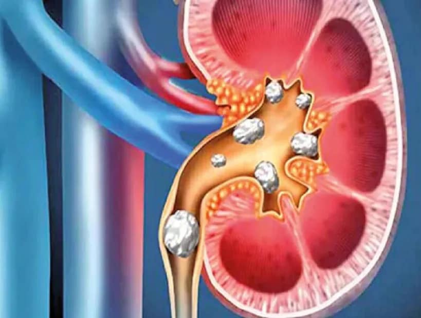 Another symptom is muscle twitching or cramps during sleep. Kidney-related imbalances in calcium and electrolytes may cause muscles to stiffen or move involuntarily. Studies show that around 30% of patients with kidney failure experience this issue, which can severely disturb sleep. If you notice this frequently, it’s advisable to get your kidney function checked through blood tests. (News18 Telugu) Another symptom is muscle twitching or cramps during sleep. Kidney-related imbalances in calcium and electrolytes may cause muscles to stiffen or move involuntarily. Studies show that around 30% of patients with kidney failure experience this issue, which can severely disturb sleep. If you notice this frequently, it’s advisable to get your kidney function checked through blood tests. (News18 Telugu)