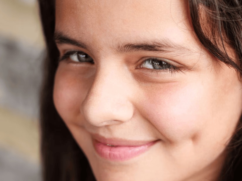 This raises the question – are dimples a defect or a decorative feature? Medically speaking, they are considered a minor congenital anomaly, a small muscle defect. However, it’s important to note that this anomaly is benign. Dimples do not indicate any underlying health concern or cause any physical discomfort. In fact, they are harmless and don’t interfere with any facial functions. (News18 Telugu) This raises the question – are dimples a defect or a decorative feature? Medically speaking, they are considered a minor congenital anomaly, a small muscle defect. However, it’s important to note that this anomaly is benign. Dimples do not indicate any underlying health concern or cause any physical discomfort. In fact, they are harmless and don’t interfere with any facial functions. (News18 Telugu)
