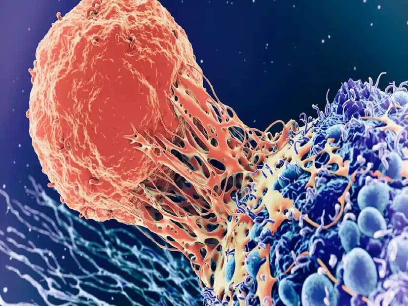 Stage Three: Cancer has now spread to major blood vessels around the pancreas or to four or more nearby lymph nodes, but not to distant organs. This is considered a locally advanced stage. The cancer reaches surrounding tissues, making treatment more complicated, although still possible with aggressive therapies. (News18 Telugu) Stage Three: Cancer has now spread to major blood vessels around the pancreas or to four or more nearby lymph nodes, but not to distant organs. This is considered a locally advanced stage. The cancer reaches surrounding tissues, making treatment more complicated, although still possible with aggressive therapies. (News18 Telugu)