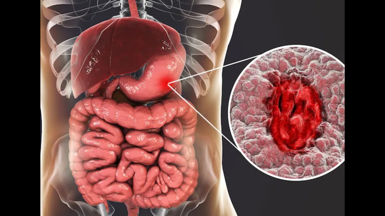 Your Gut Could Be In Danger: How Common Painkillers Are Silently Damaging Your Intestines