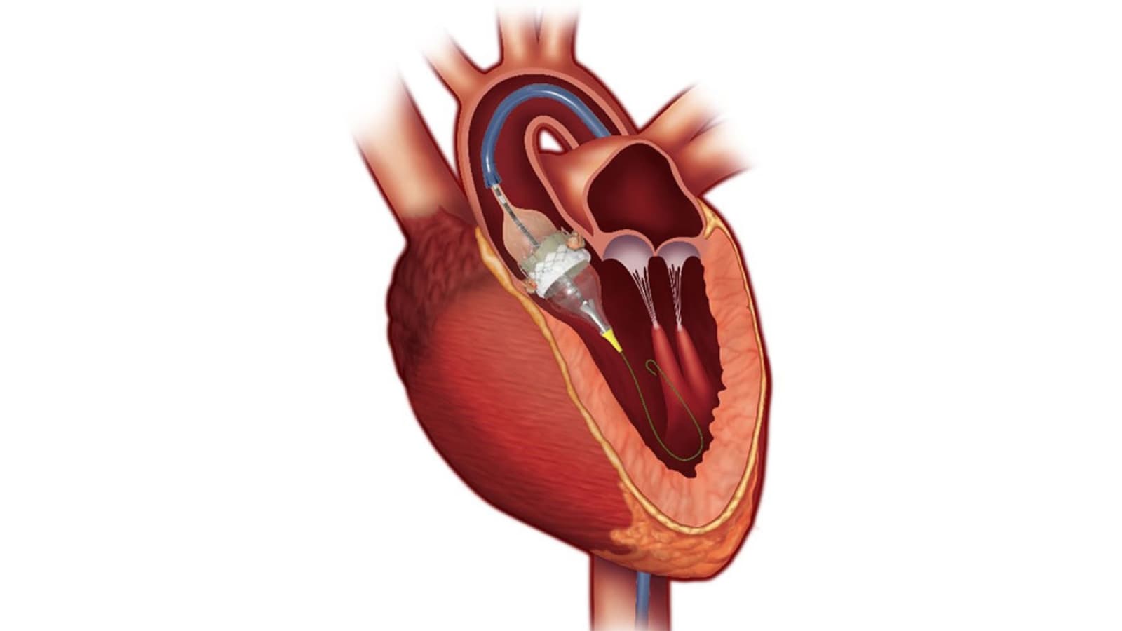 Structural Heart Disease: New Treatments Emerge