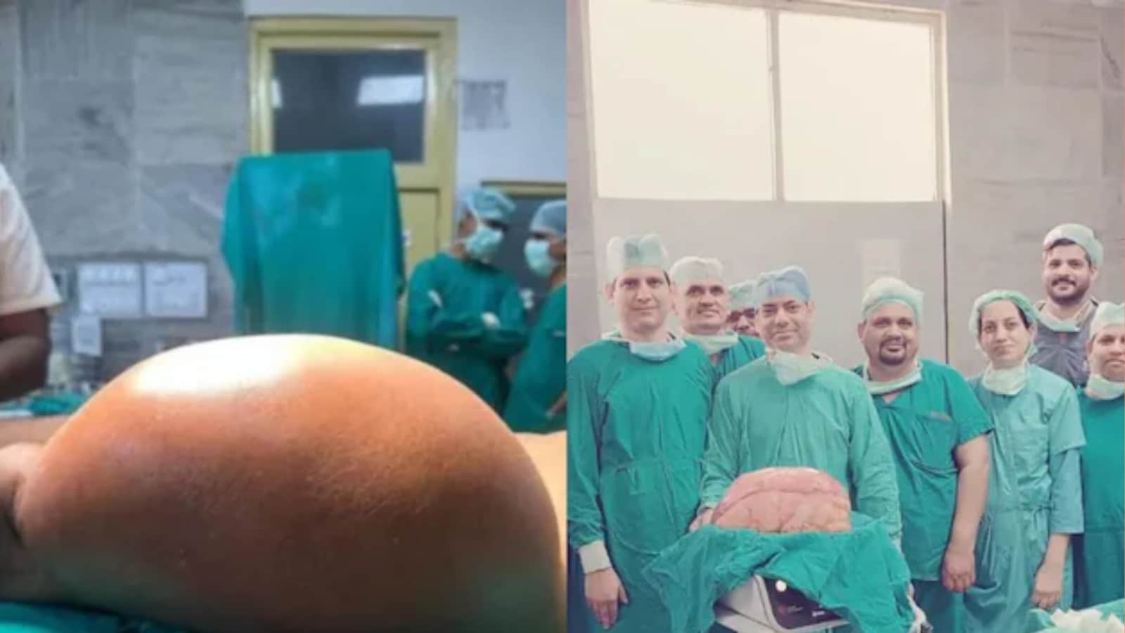 Jaipur Hospital Removes 8.4kg Thigh Tumor From Man