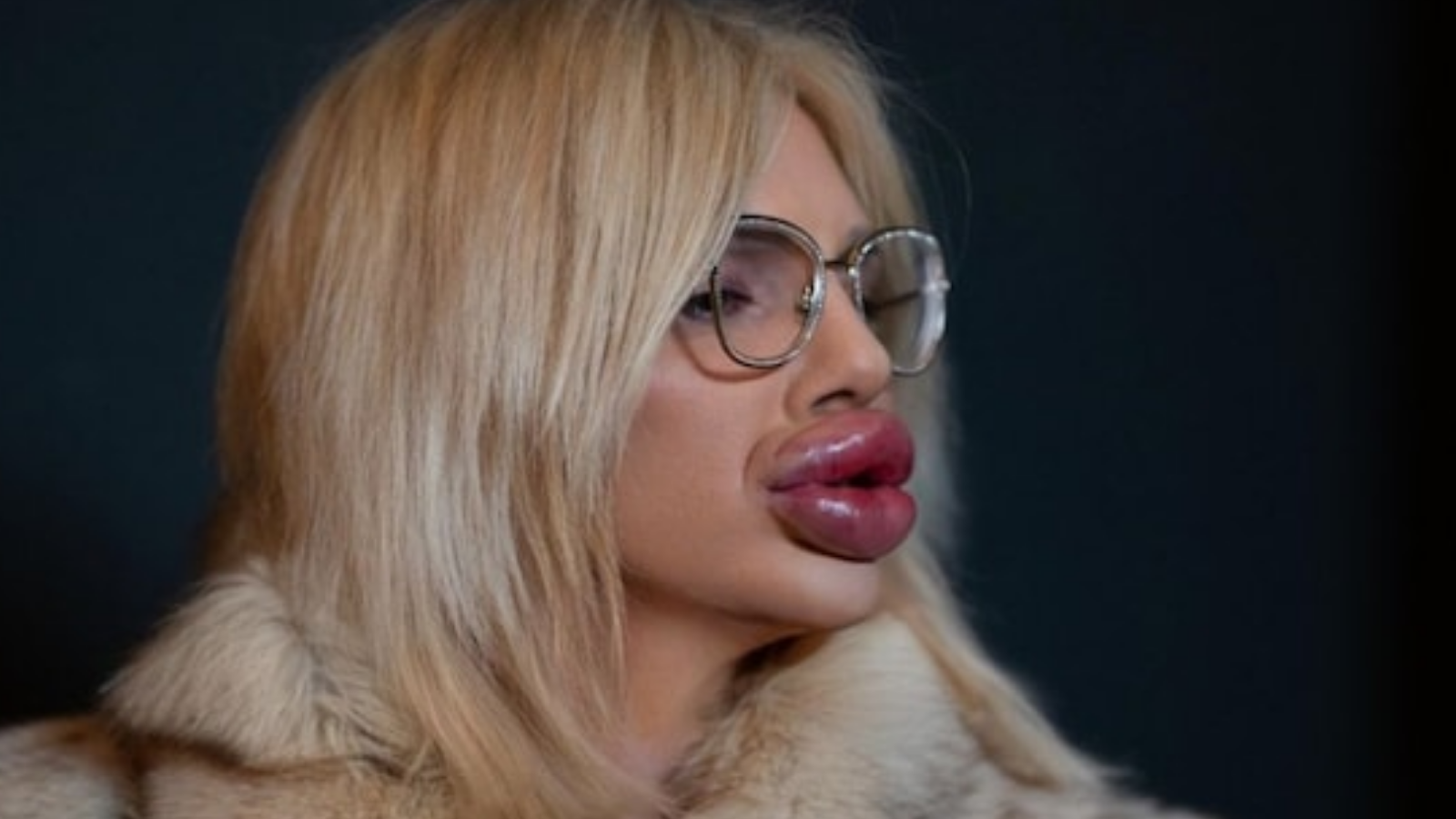 This Woman Spent Rs 39 Lakh To Have The 'Biggest Lips In The World'. But She Wants To Go Bigger | Viral News - News18