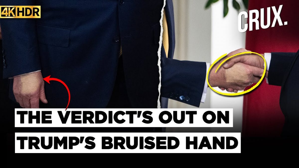 Trump Diagnosed With Chronic Venous Insufficiency