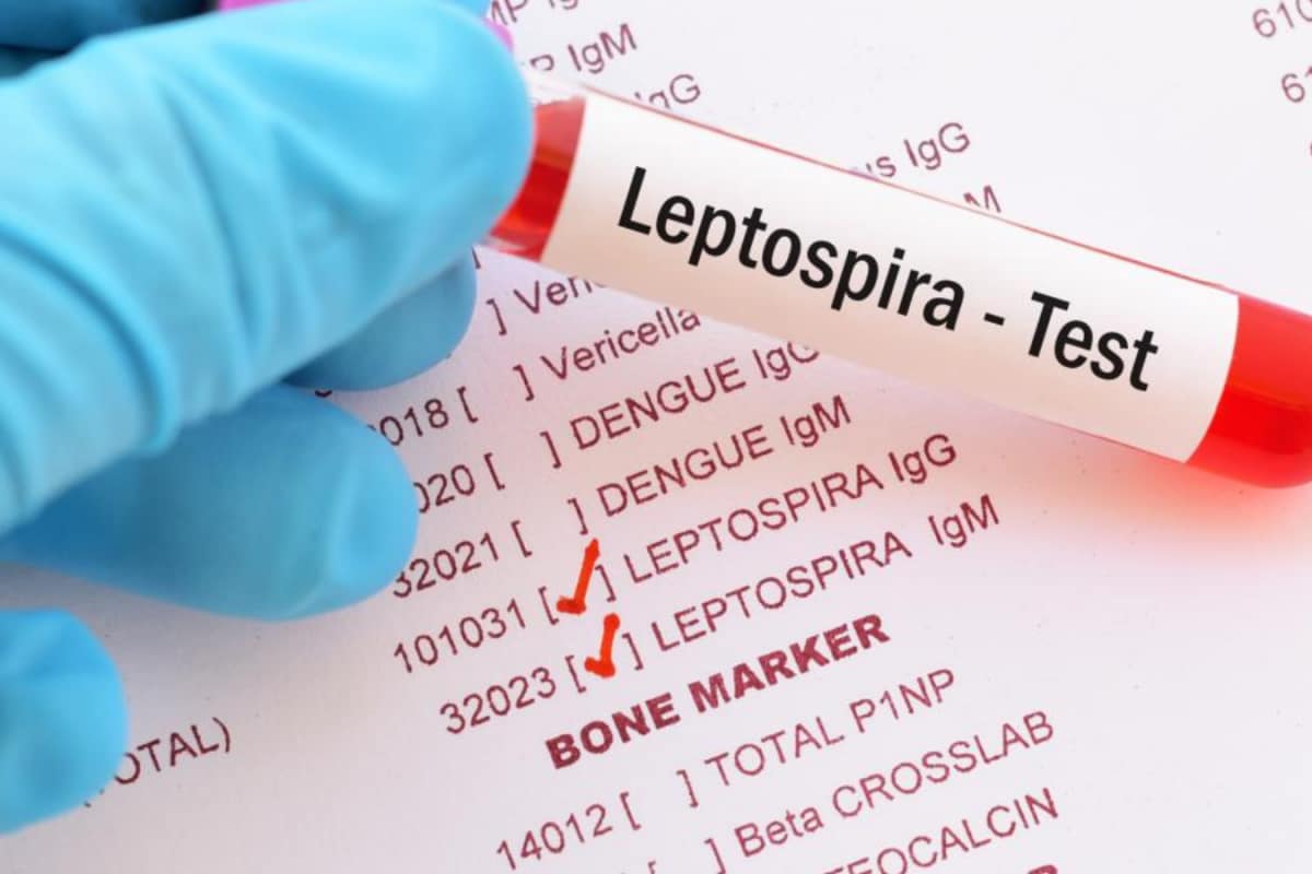 Monsoon And Leptospirosis: What You Need To Know To Stay Safe