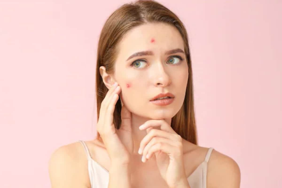 Pimples Getting Worse During The Rainy Season? Here’s How To Keep Your Skin Clear