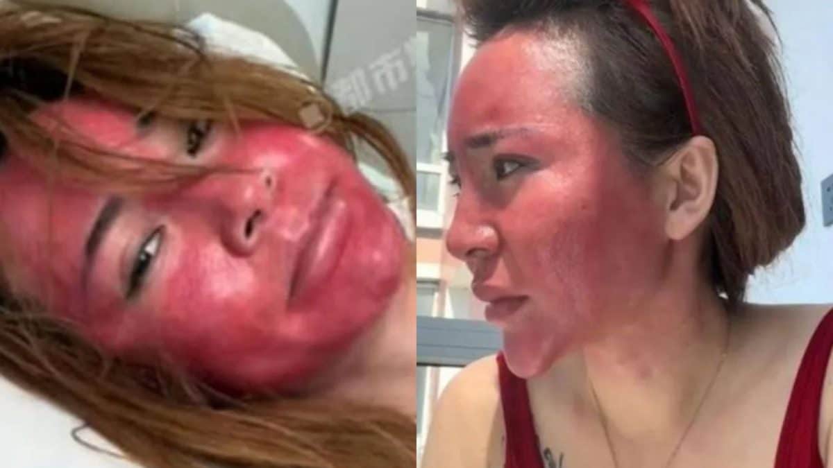 22 Years Of Makeup, No Face Wash: Chinese Woman’s Face Swells, Turns Purple From ‘Hormone Rash’