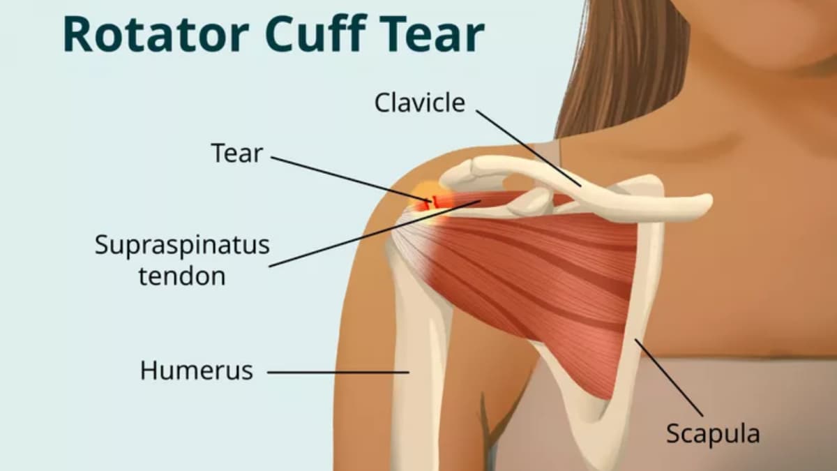 Shoulder Weakness And Stiffness: Early Signs Of Rotator Cuff Damage