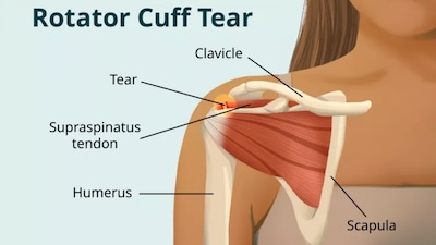 The rotator cuff, a group of muscles and tendons, helps stabilize the shoulder joint and enables free movement
