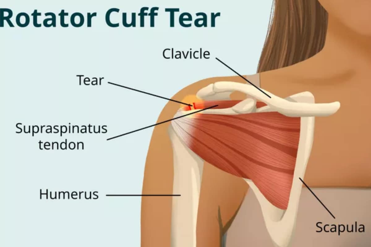 Shoulder Weakness And Stiffness: Early Signs Of Rotator Cuff Damage
