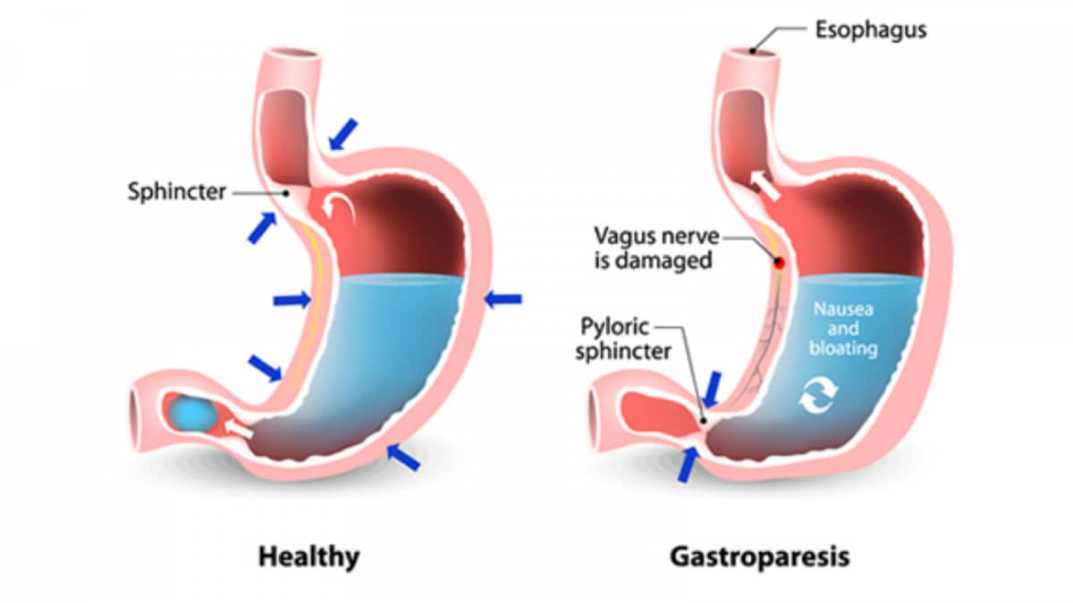 Myths Buster: 8 Beliefs About Gastroparesis And Why They Are Wrong… No, It’s Not Just ‘Gas’
