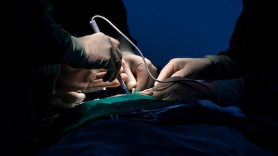 Hospital officials said the surgery was successful and the patient is recovering.(Representative Image)
