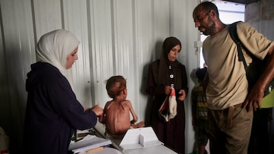 A malnourished Palestinian child receives a check-up in al-Mawasi, Khan Yunis, southern Gaza Strip, on August 13. (AFP photo)