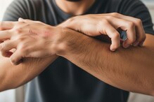 Can Food Choices Reduce Psoriasis Symptoms? Here's What A Dermatologist Says