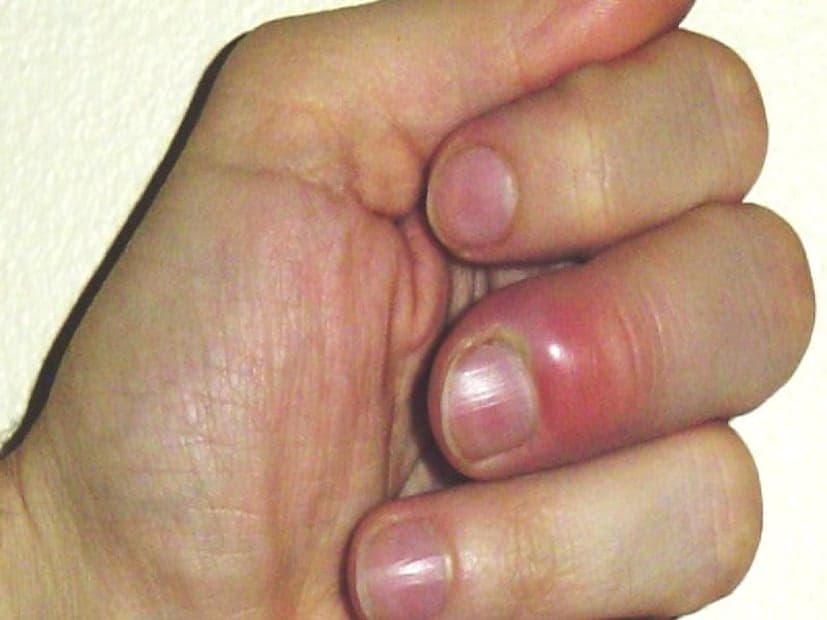 Changes in the nails can also signal potential heart issues. If the base of the nail becomes red and swollen, or if the tip of the nail bends downward, it could point to a heart infection. Red or purple spots under the nails are another sign that should not be ignored. (News18 Bengali) Changes in the nails can also signal potential heart issues. If the base of the nail becomes red and swollen, or if the tip of the nail bends downward, it could point to a heart infection. Red or purple spots under the nails are another sign that should not be ignored. (News18 Bengali)