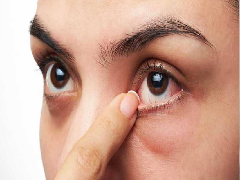 Greyish round spots near the pupil of the eye may also indicate underlying heart disease. Research published in Medical News Today refers to a 2003 study involving 515 female heart attack survivors. It revealed that most women had experienced symptoms nearly a month before their attack. (News18 Bengali) Greyish round spots near the pupil of the eye may also indicate underlying heart disease. Research published in Medical News Today refers to a 2003 study involving 515 female heart attack survivors. It revealed that most women had experienced symptoms nearly a month before their attack. (News18 Bengali)