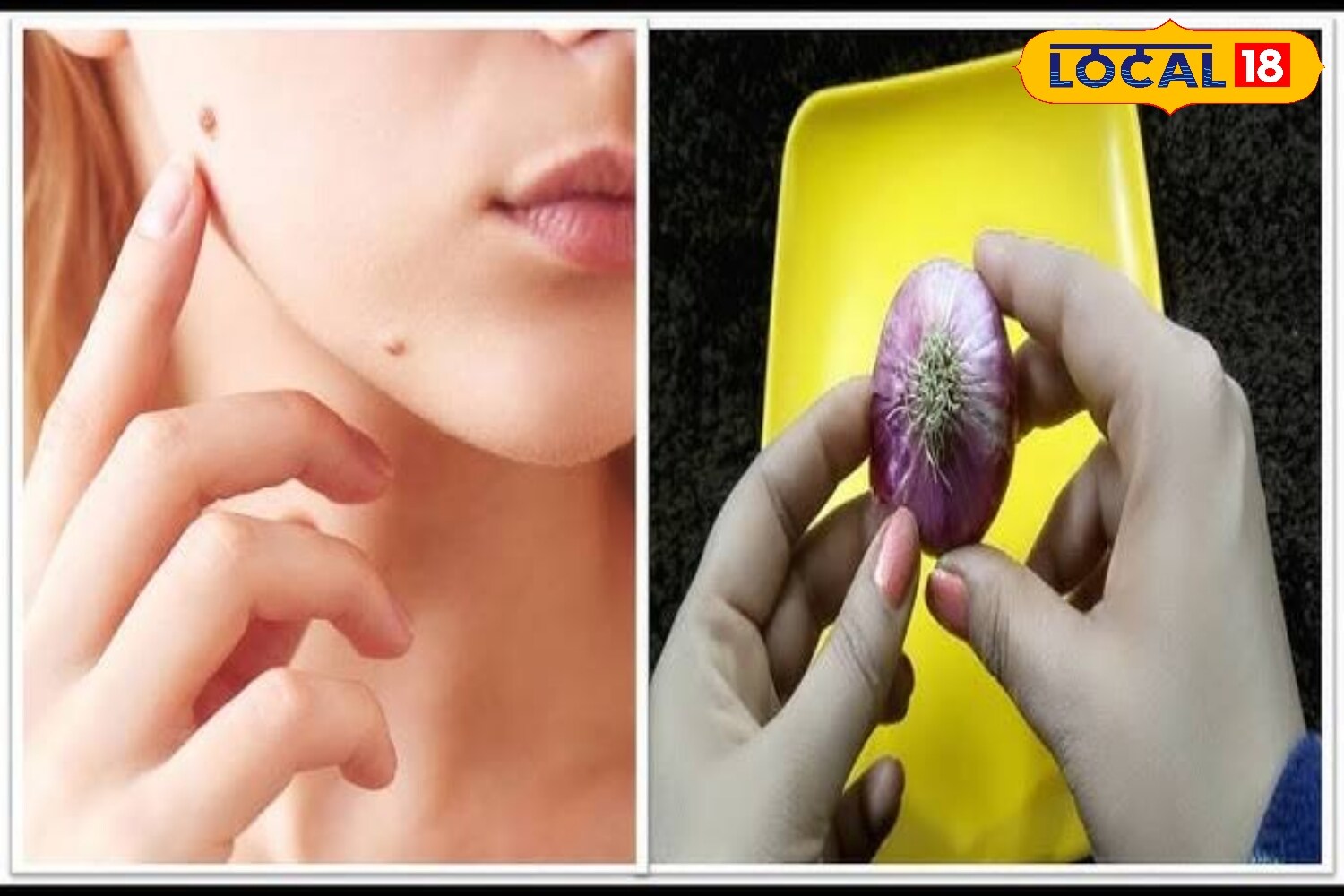 Onion and garlic juice: Onion juice is believed to be effective in treating warts, while garlic juice helps reduce moles. Applying the juice lightly on the affected area and leaving it for some time can yield visible results with regular use. (News18 Hindi) Onion and garlic juice: Onion juice is believed to be effective in treating warts, while garlic juice helps reduce moles. Applying the juice lightly on the affected area and leaving it for some time can yield visible results with regular use. (News18 Hindi)