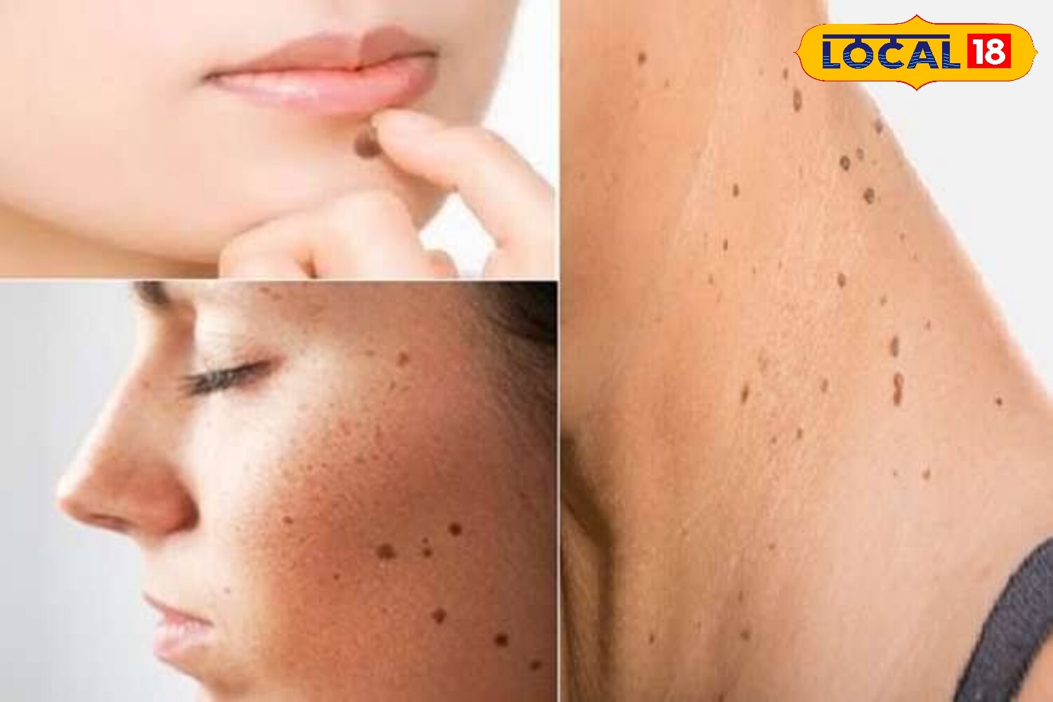 Turmeric and honey: Mix a pinch of turmeric with one teaspoon of honey, apply it on the mole, and wash with lukewarm water after 15 minutes. This remedy helps lighten moles and keeps the skin soft. (News18 Hindi) Turmeric and honey: Mix a pinch of turmeric with one teaspoon of honey, apply it on the mole, and wash with lukewarm water after 15 minutes. This remedy helps lighten moles and keeps the skin soft. (News18 Hindi)