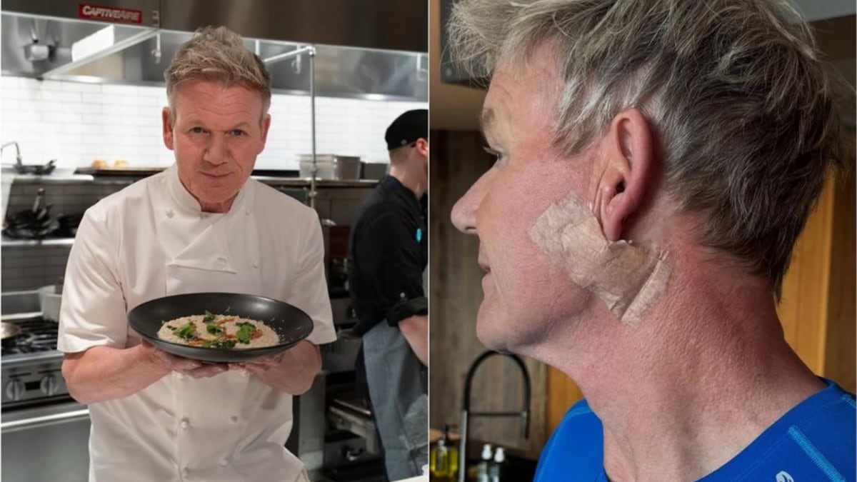 Gordon Ramsay’s Skin Cancer Surgery Sparks Warning: Sunscreen Is Non-Negotiable