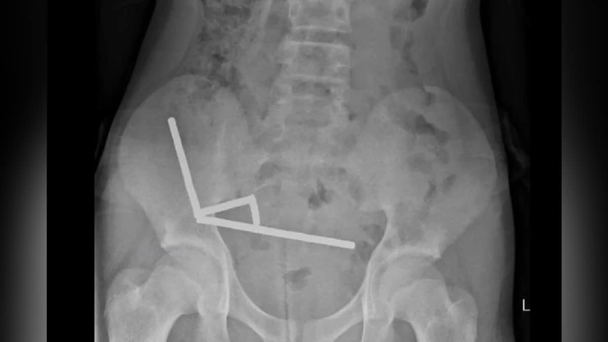 New Zealand Teen Undergoes Surgery After Swallowing 100 Magnets, Gets Parts Of Intestines Removed