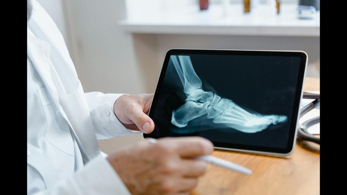 <div>Silent 'Bone Death' On The Rise After Covid-19, Doctors Flag Surge In Young Adults</div>