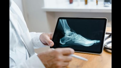 Doctors are seeing weak bones that break easily and long-lasting hip pain due to dying bone tissue. (Pexels Image for Representation)