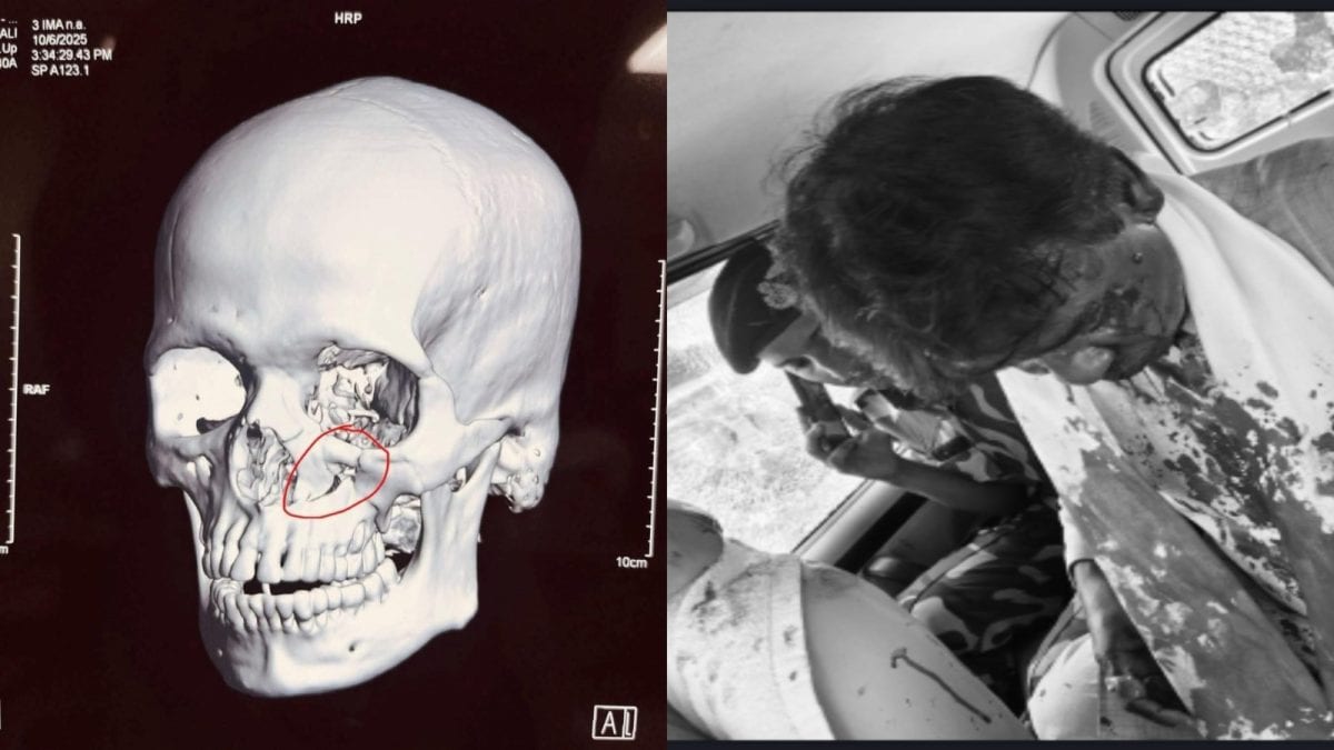 <div>'Could Have Lost Vision': BJP Claims Khagen Suffered Fracture Below Eye In Stone-Pelting Attack</div>