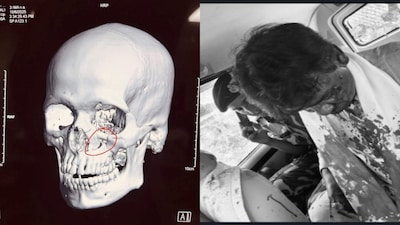 BJP Claims Khagen Suffered Fracture Below Eye In Stone-Pelting Attack 