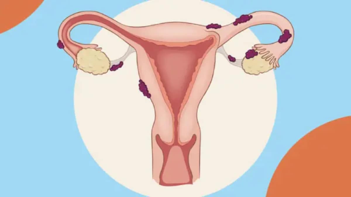 Endometriosis: Separating Myths From Medical Facts