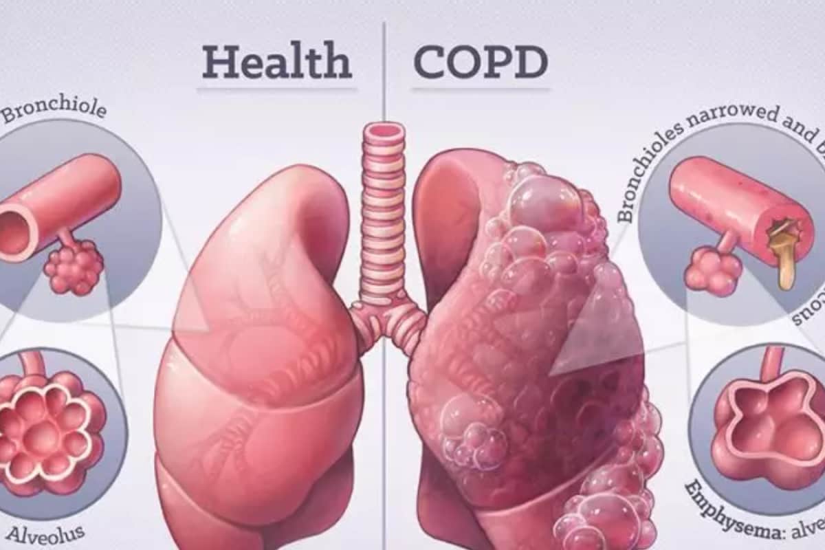 Why Winter Air Is Especially Dangerous For COPD Patients: Experts Explain The Hidden Triggers